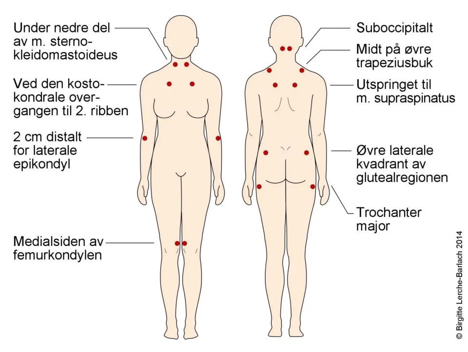 Fibromyalgi og kiropraktorbehandling